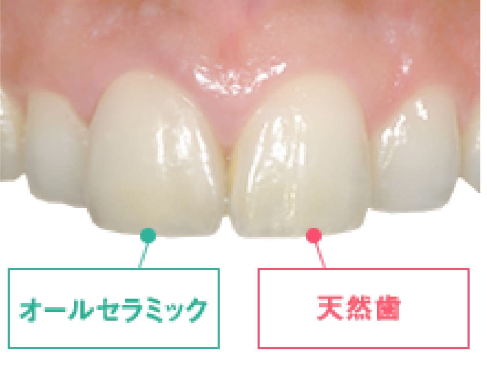 大人の矯正治療